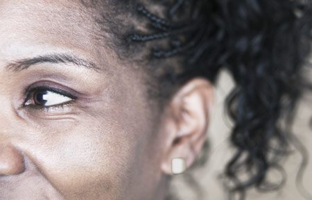 Gesicht einer Frau mit Pigmentstörungen